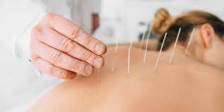 Acupuncture